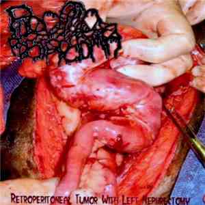 Pilocystic Astrocytoma - Retroperitoneal Tumor With Left Nephrectomy album